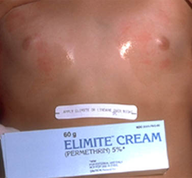 Elimite For Scabies