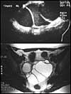 Large ovarian mass