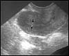 Normal uterus with a thin lining