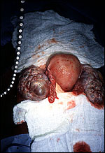 Theca lutein cysts