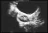Polycystic ovary-pearl necklace sign