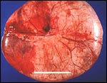 Serous cystadenoma