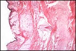Mature cystic teratoma-microscopic
