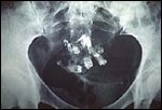 Radiograph of ovarian teratoma with teeth.